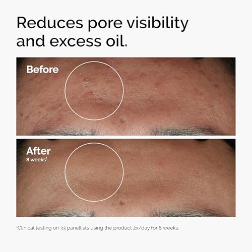 The Ordinary Niacinamide 10% + Zinc 1%, Smoothing Serum for Blemish-Prone Skin