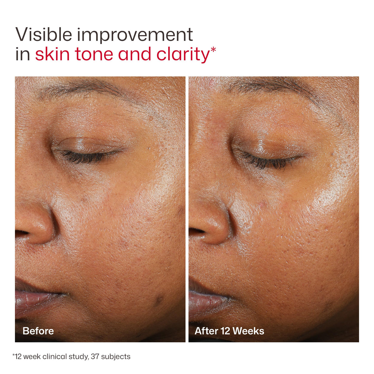 EltaMD UV Clear Face Sunscreen with Zinc Oxide, Oil-Free, SPF 46 and SPF 50 | Calms and Protects Acne-Prone Skin and Rosacea, No White Cast, Dermatologist Recommended, Available in Three Tints and Sizes