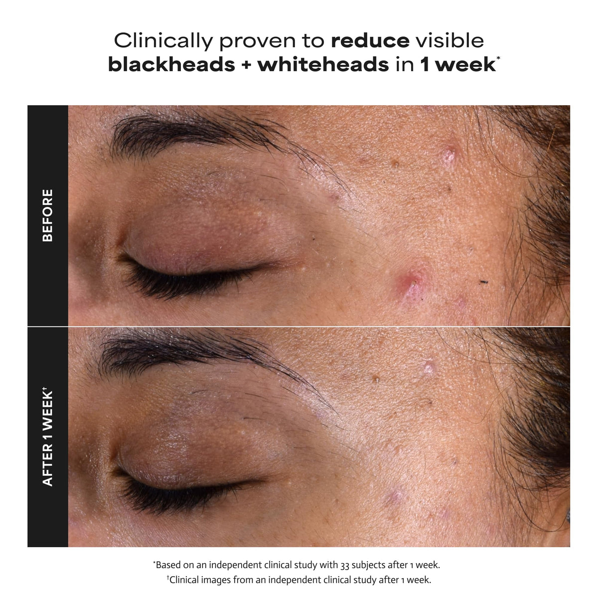 Paula's Choice SKIN PERFECTING 2% BHA Liquid Leave-On Exfoliant | Gentle Salicylic Acid Leave-On Facial Exfoliator for Blackheads, Enlarged Pores, Wrinkles & Fine Lines