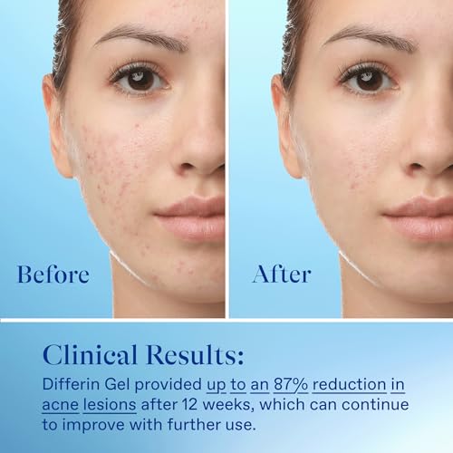 Differin Acne Retinoid Treatment Gel, 0.1% Adapalene, 15g Tube | Over-The-Counter Retinoid, Clears Acne And Prevents Breakouts, Gentle For Sensitive Skin, 30-Day Supply, 15G Tube