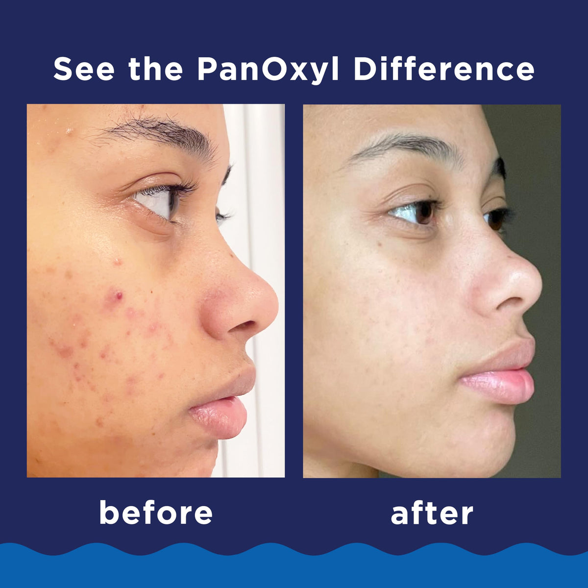 PanOxyl Acne Foaming Wash, 10% Benzoyl Peroxide, For Face & Body, 5.5 oz | Maximum Strength, Antibacterial Daily Cleanser, Treats & Prevents Acne, Non-Comedogenic, Vegan, Unscented, All Skin Types